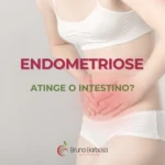 Mulher em pose relaxada discute a relação da endometriose com o intestino.